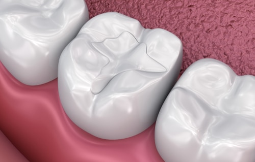 Dental Fillings in Harrisburg, NC Tooth-Colored Composite Fillings