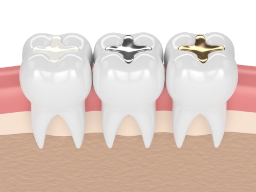 Dental Fillings in Harrisburg, NC Tooth-Colored Composite Fillings