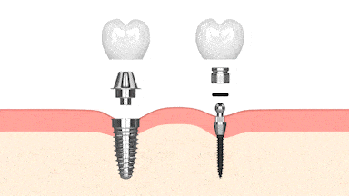 Dental Implants in Harrisburg Implant Dentist David P. Ney, DDS