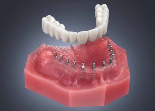 Dentures in Harrisburg, NC  Implant Denture Options  Dr. Ney