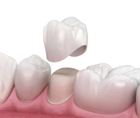 Dental Crowns in Harrisburg, NC  Cosmetic Dentist  Dr. David Ney