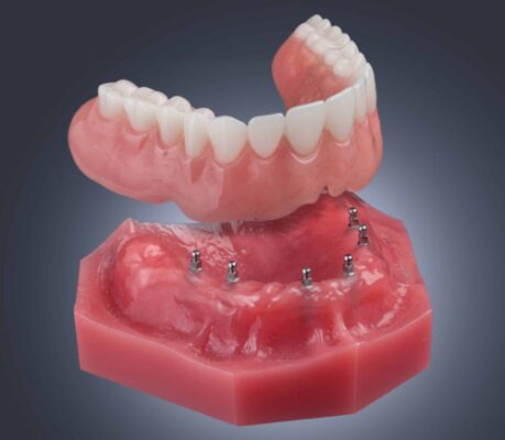 Denture Options in Harrisburg, NC | Charlotte Implant Dentist