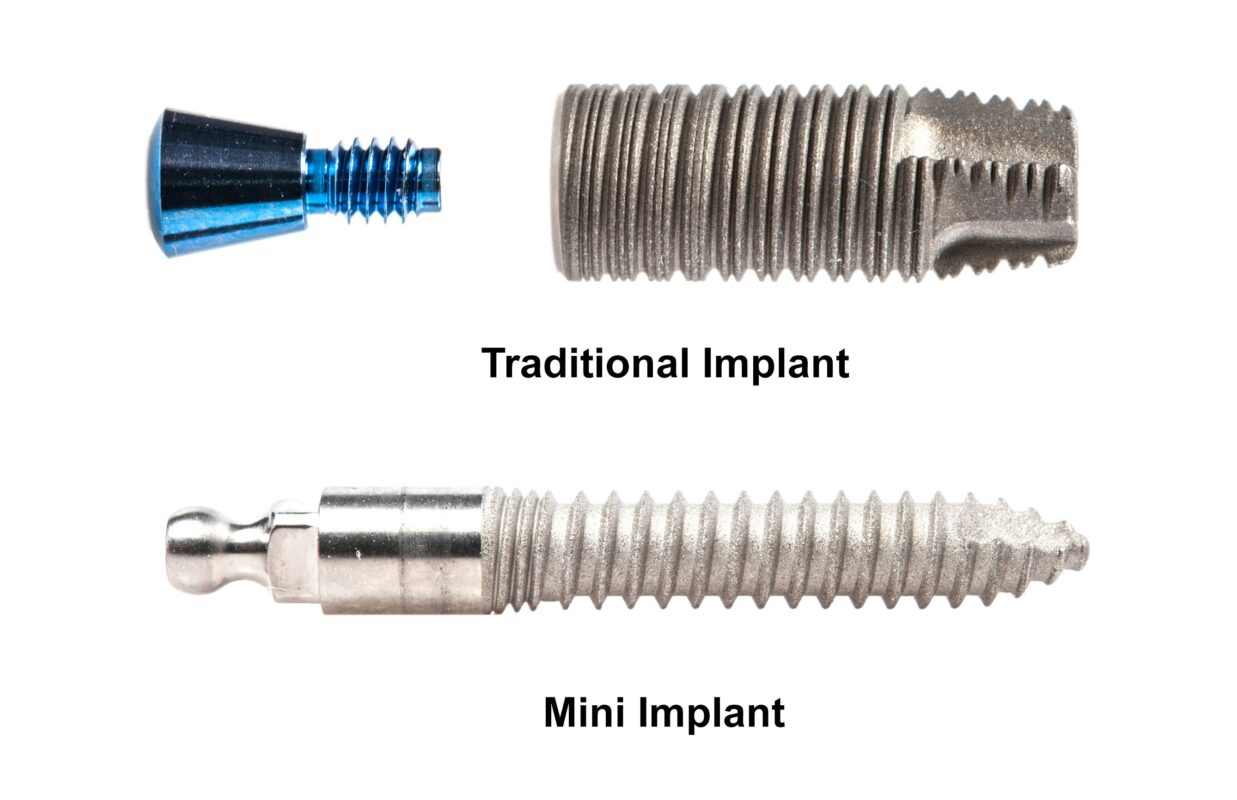 Mini Implants in Harrisburg, NC Charlotte Dental Implant Dentist