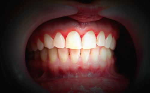 Periodontal Maintenance in Harrisburg, NC  Gum Disease Dentist