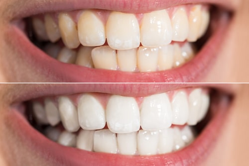 Teeth Whitening in Harrisburg, NC David P. Ney, DDS