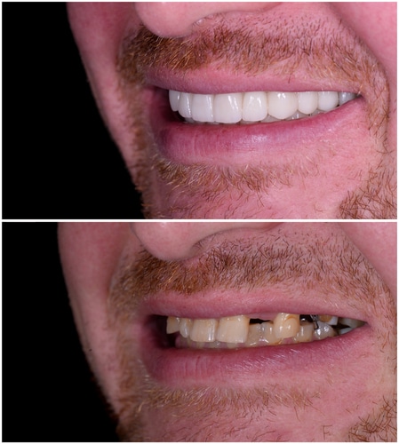 Full-Mouth Reconstruction in Harrisburg, NC David P. Ney, DDS