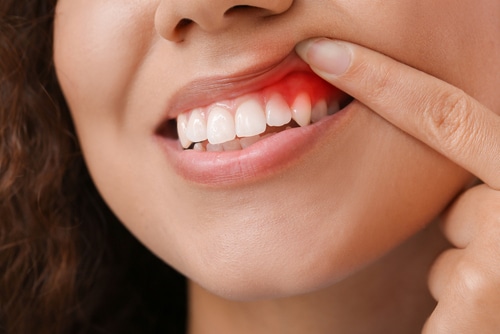 Bleeding Gums: A Sign of Gum Disease | Harrisburg, NC | Dr. Ney