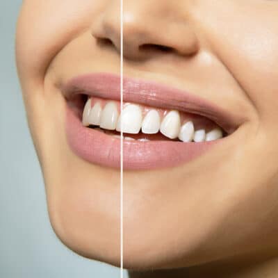 Teeth Bleaching in Harrisburg, NC | Cosmetic Dentistry | Dr. Ney